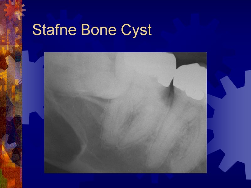 Stafne Bone Cyst